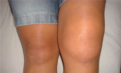 Causes of knee joint articulation