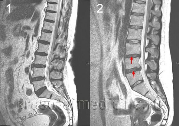 Osteochondral disease of the spine
