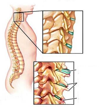 Comparing healthy and sick vertebrae on the neck