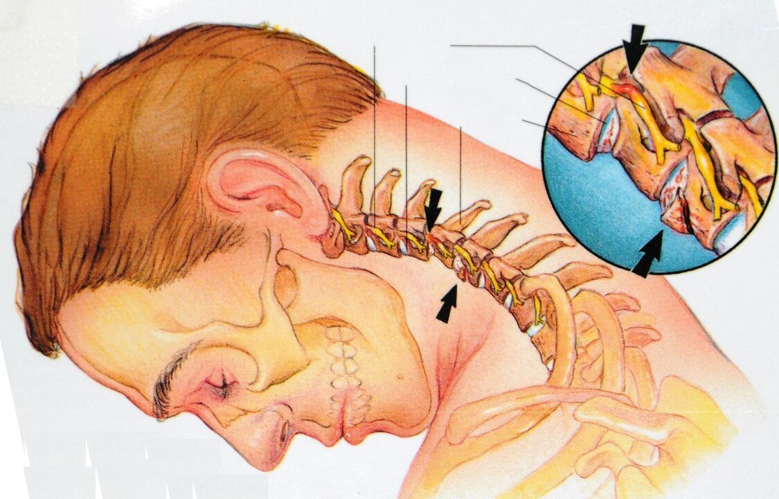 Osteochondral disease in the cervical area
